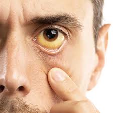 Image result for hepatitis symptoms