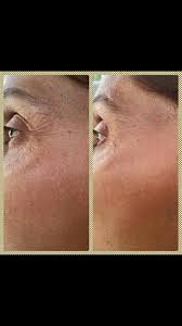 Lr Healht Beauty Serox Goz Pedi Uygulamasi