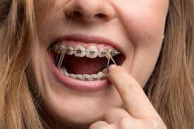 Maybe you would like to learn more about one of these? Interarch Elastics Are Important To A Successful Orthodontic Outcome Manilla Orthodontics