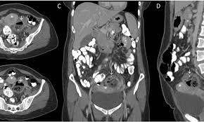 We did not find results for: Woman S Infected Ovarian Cyst Had Traces Of A Vegetable She Had Eaten In It Daily Mail Online