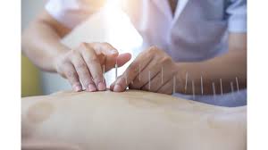 Image result for Acupuncture