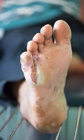 Image result for diabetic toes