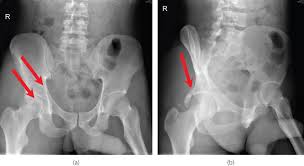 Maybe you would like to learn more about one of these? Pelvis And Hip Radiology Key
