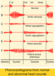 Aortic Stenosis Wikipedia