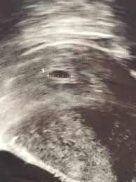 Die wahrscheinlichkeit, drillinge zu erwarten, liegt ungefähr bei 1. Ultraschall Weicht Ab Von Ssw Schwangerschaftsgruppe Babycenter