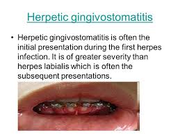 Gingivostomatitis is a combination of gingivitis and stomatitis, or an inflammation of the oral mucosa and gingiva. Herpes Simplex Herpes Simplex Greek á¼•rphs Herpes Lit Creeping Is A Viral Disease Caused By Both Herpes Simplex Virus Type 1 Hsv 1 And Type Ppt Download