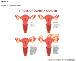 The new, validated endometriosis staging system. Ovarian Cancer For Aprns Nursing Ce Course Nursingce