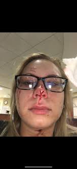 Traumatic Dog Bite Experience and Ongoing Fear