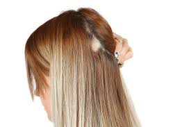 Haarausfall Frauen Mittel Gegen Diffusen Erblich Bedingten Haarverlust Haarausfall Hilfe