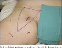 The cancer has spread to distant parts of the body (any t, any n, m1). Pdf Videoscopic Inguinal Lymphadenectomy For Metastatic Melanoma Semantic Scholar