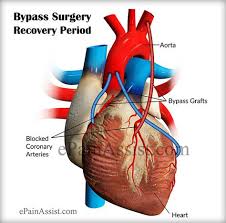 Bypass Surgery Recovery Period What To Expect After Bypass Surgery Heart Surgery Recovery Bypass Surgery Surgery Recovery