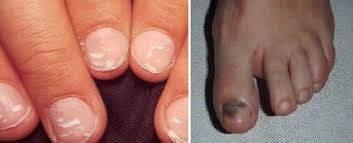 nagelpilz symptome konnen wie schwarze oder weisse flecken auf den nageln erscheinen die nicht auf den die er nail fungus nail fungus treatment nails