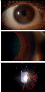 In many cases, the cause is unknown. Uveitis For The Non Ophthalmologist The Bmj