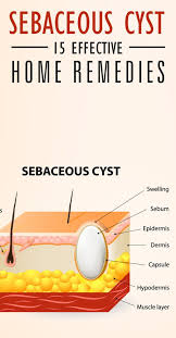 14 Home Remedies To Treat Sebaceous Cysts Health Remedies Health Remedies