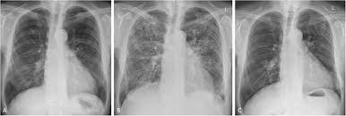 Image result for XRay Changes in Rheumatic Conditions