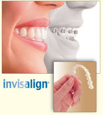 The best way to straighten teeth without braces involves using some sort of cle. Straight Teeth Without Braces It S True With Invisalign It Is Possible To Have Straight Teeth In As Straight Teeth Without Braces Dental Braces Invisalign