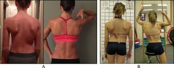 It then transmits signals back to these areas and other parts of the cerebral cortex. Physiotherapy Scoliosis Specific Exercises A Comprehensive Review Of Seven Major Schools Scoliosis And Spinal Disorders Full Text