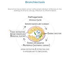 Image result for Bronchiectasis