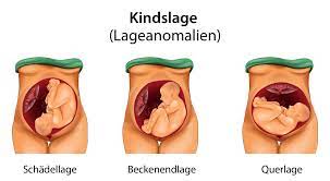 Da sie auch in den letzten wochen noch größer werden, wird es in der gebärmutter immer enger und die wahrscheinlichkeit für eine spontane drehung sinkt. Kindslage Lageanomalien Ursachen Formen Folgen
