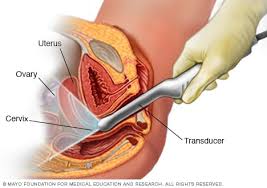 Endometriosis can be a challenging condition to manage. Endometriosis Diagnosis And Treatment Mayo Clinic