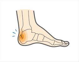 Recover from a broken heel. Calcaneal Stress Fracture Upswing Health