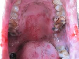 Image result for Oral herpes roof of mouth