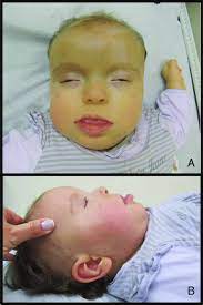 Some institutions, such as the genectis home. Patient 5 Dysmorphic Features Described In Pks Frontotemporal Download Scientific Diagram