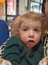 Koorsblaar-nadraai: My baba is blind gelaat ná iemand hom 'n soen gee