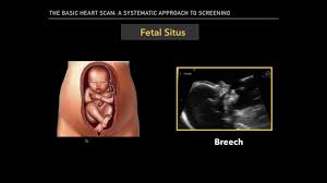 The Basic Fetal Heart Scan Youtube If a fetal heartbeat cannot be identified with a crl ≥7 mm using transvaginal scanning, then embryonal demise can be diagnosed 3,4.demise can be confirmed with repeated scanning and serial. the basic fetal heart scan
