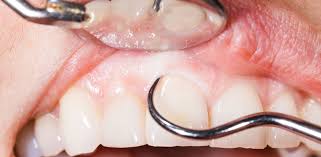 How much is a teeth cleaning without dental insurance. Dental Deep Cleaning Srp 209 Nyc Dental