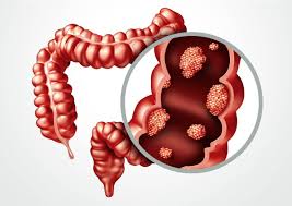 The problem is that it will not detect precancerous lesions. Types Symptoms And Screening Of Intestine Cancer Mhospital