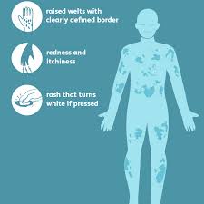 Find out why your congestion seems to get worse at night and what you can do to treat nighttime stuffiness. Urticaria Hives Signs Symptoms And Complications