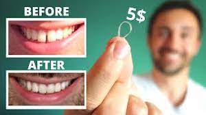 The top teeth had bondings applied to fix the chip and about 3/5s close the gap. Diy Close Gap Teeth At Home My Update Youtube
