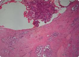 Histopathology falls within the larger field of pathology. Histological Features Of The Malignant Mesothelioma Papillary Download Scientific Diagram