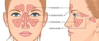 Unterstützend wirken abschwellende und schleimlösende mittel. Stirnhohlenentzundung Sinusitis A Vogel