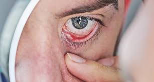 Image result for Dry Eye