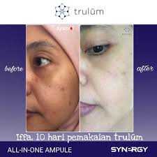 Jual Obat Jerawat Di Hidung Trulum Indonesia Di Daerah Bandar Lampung Whatsapp 08112338376 Solusi Jerawat Mau Wajah Cerah Putih Al Obat Jerawat Jerawat Herbal