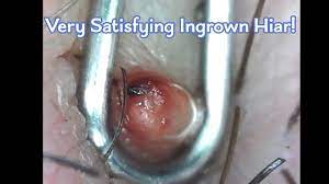 More commonly known as razor bumps, this group of little bumps is common on the beard area after you've shaved, waxed, or tweezed to remove. Heavily Infected Ingrown Hair Microscopic Removal Warning Blood Shown Youtube