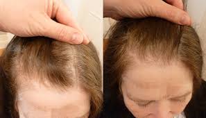 Hair loss in black women is incredibly common. Female Pattern Baldness International Hair Studio