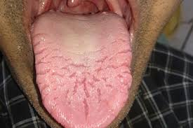 Image result for Fissured tongue