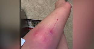 Woman Gets Flesh Eating Bacteria From Beach In Virginia Cbs 17