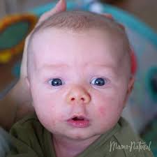 Baby Acne What Causes It How To Treat Naturally Mama Natural