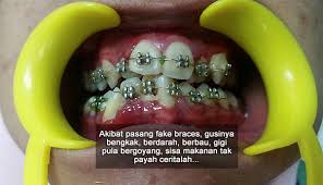 Terdapat 2 jenis braces iaitu jenis biasa (metal braces) dan jenis seramik. Doktor Tolong Buang Fake Braces Ni Saya Dah Tak Tahan Sakit The Reporter