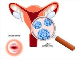 However, cell changes in the cervix can be detected at a very early stage and. Hpv Vaccination And Fertility