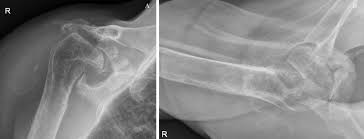 Image result for Chronic Shoulder Dislocation