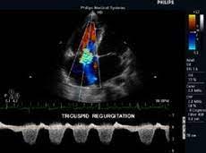 It is a type of medical imaging of the heart, using standard ultrasound or doppler ultrasound. Echokardiographie Lebach Saarlouis Angiologe Internist Arzt Spezialist