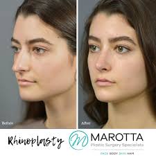 Gorgeous results like these are a perfect example of why it is so important  to choose a Facial Plastic Surgeon for your Rhinoplasty procedure 🤩. . As  a surgeon who has focused