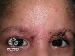 Image result for ekzema face