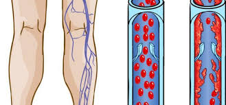 V prípade tepnovej (artériovej) trombózy tak dochádza k ischémii (nedokrveniu) časti tela. Venous Thrombosis Medixa Org