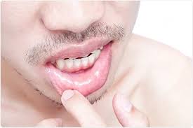 Image result for oral herpes symptoms roof of the mouth